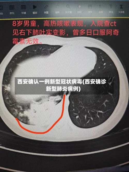 西安确认一例新型冠状病毒(西安确诊新型肺炎病例)